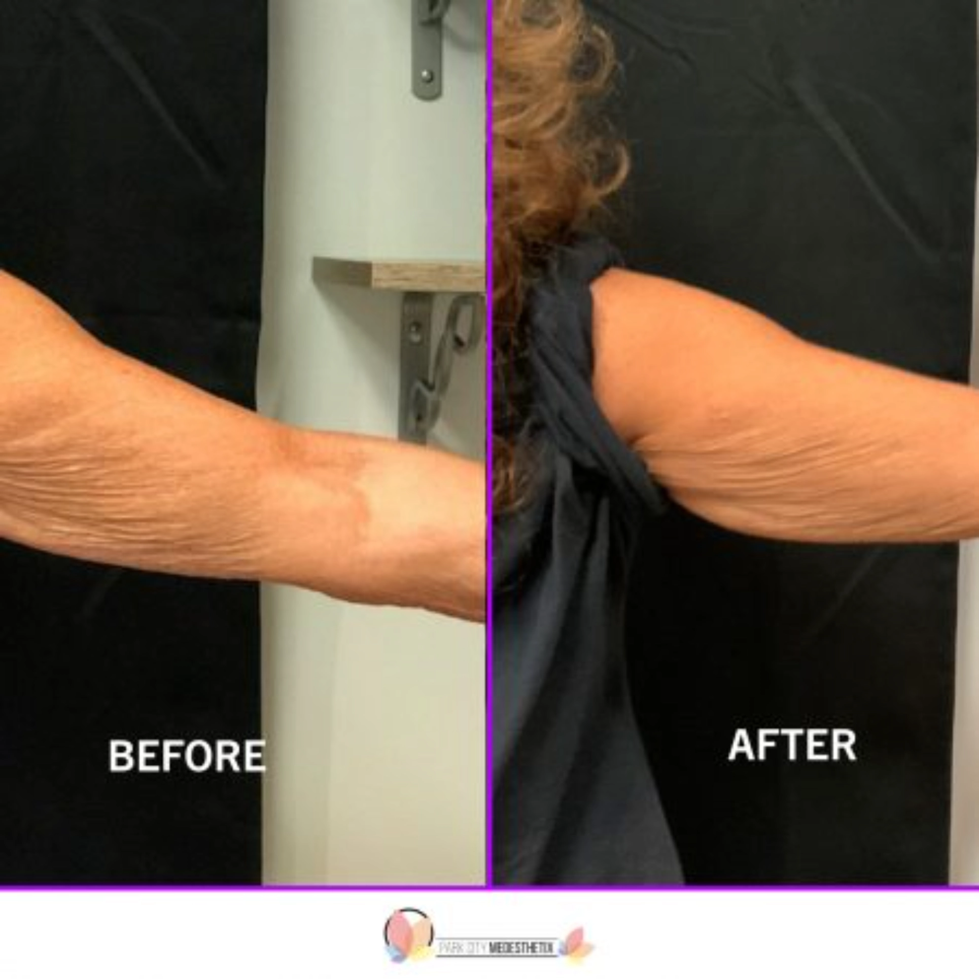 Skin Tightening Park City