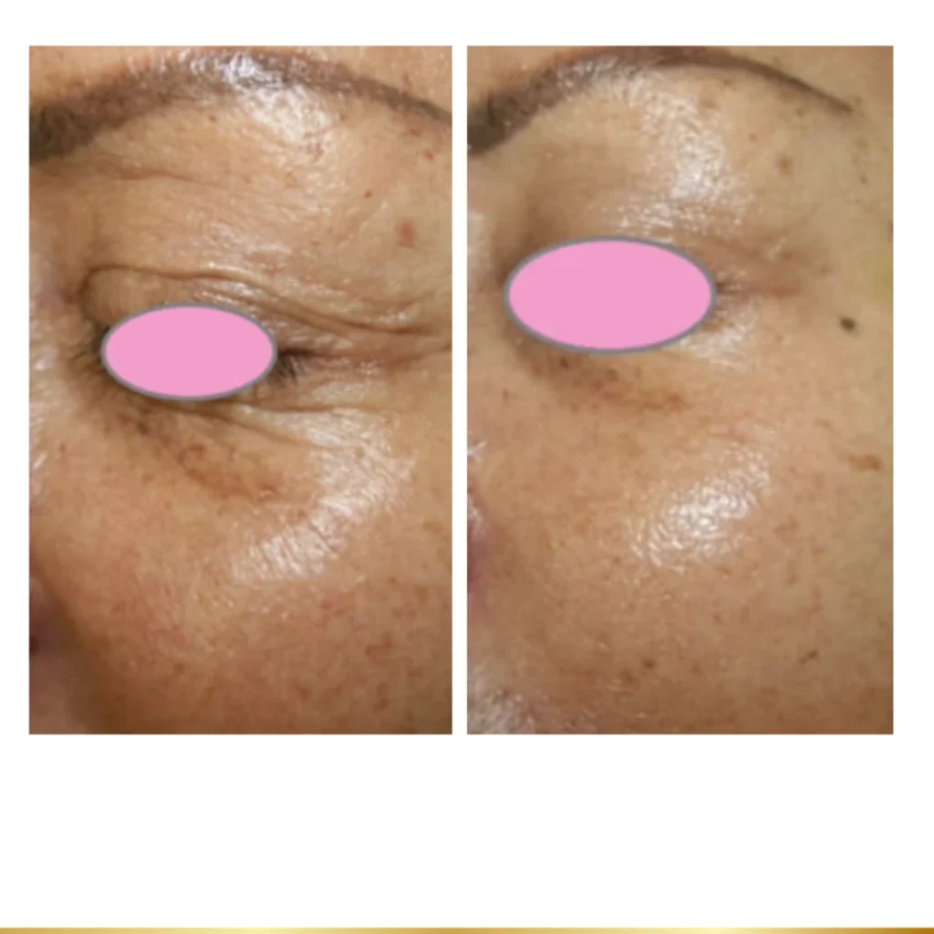 Before and after under-eye treatment showing reduced wrinkles, smoother skin, and brighter texture