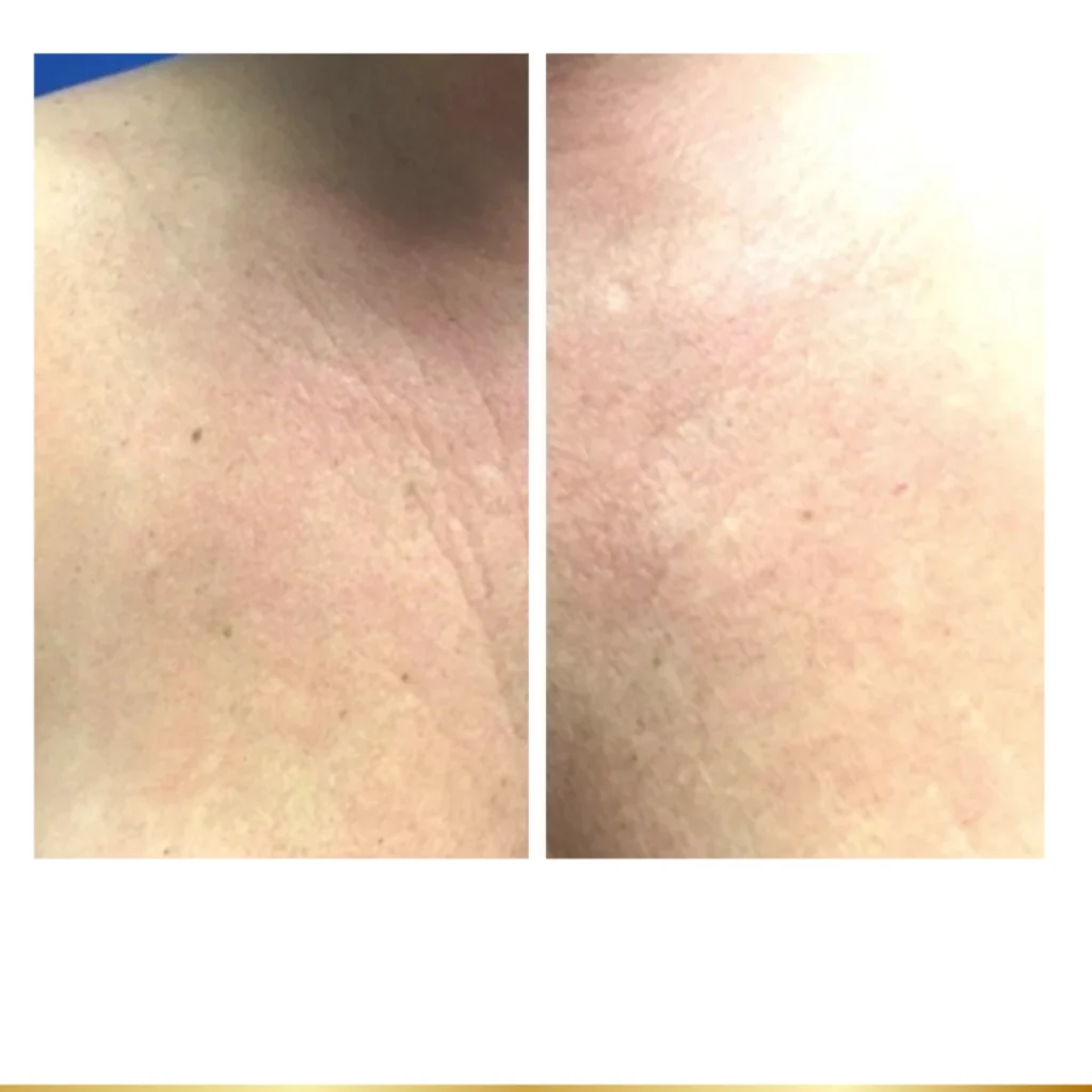 Collagen-boosting treatment before and after improving chest texture and tone