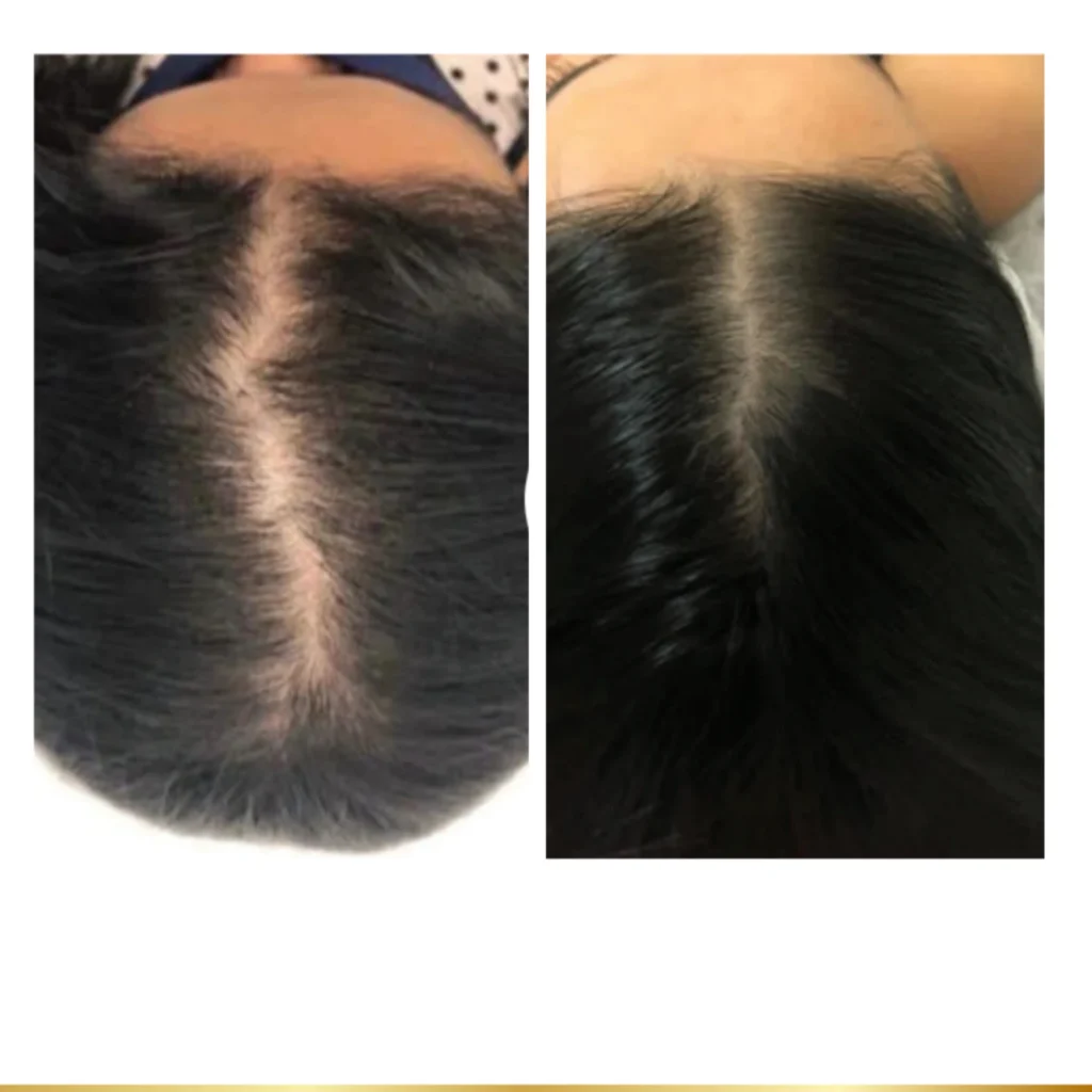 Before and after mesoneedling treatment on scalp.
