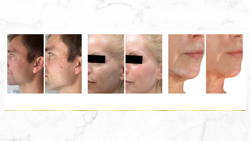 Skin rejuvenation with microneedling treatment improving texture and fine lines
